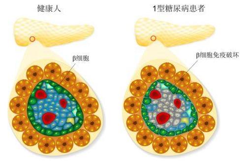 发现削弱1型糖尿病Treg分化和稳定性的新机制