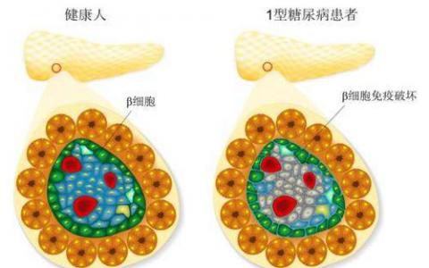 发现削弱1型糖尿病Treg分化和稳定性的新机制