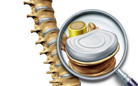 开发出功能强大的新工具来预测患者的脊柱骨折