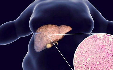 科普日常饮食中多吃4种好食物及查出脂肪肝饮食无需太多改变