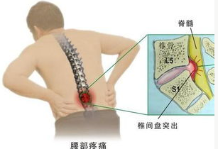 科普腰突患者注意饮食没那么难及不吃油条和辛辣可避开老年痴呆症