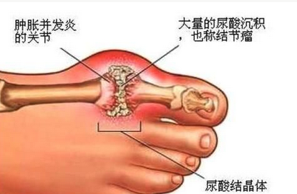 教你怎么吃才健康及痛风患者饮食须谨遵这三不要