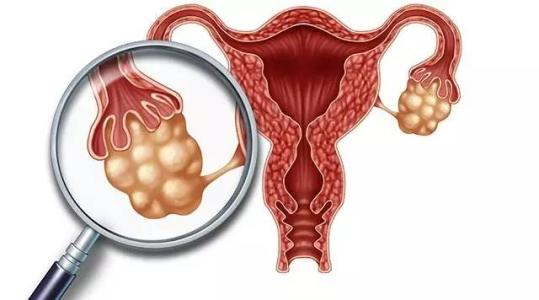 HPV相关宫颈癌的尿液测试显示出增加筛查机会的潜力