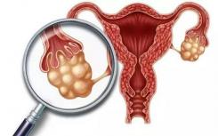 HPV相关宫颈癌的尿液测试显示出增加筛查机会的潜力