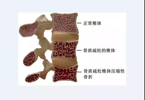 讲解早期骨质疏松都有哪些症状以及怎么饮食补钙