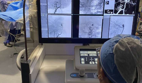 外科医生使用机器人成功治疗了脑动脉瘤
