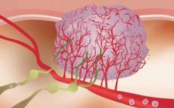 UCI神经肿瘤学家采用综合方法对抗脑癌
