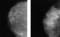 在致密的乳房中发现癌症时简化的MRI优于3D乳房X光照片