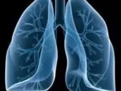 科学家发现与特发性肺纤维化有关的三个基因