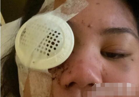 【可怕】美国一亚裔女孩凌晨被人开枪打穿右眼 住院后又被确诊新冠