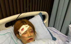 网红王多鱼怎么了被男友家暴是怎么回事?王多鱼被打住院照片是真的吗什么情况