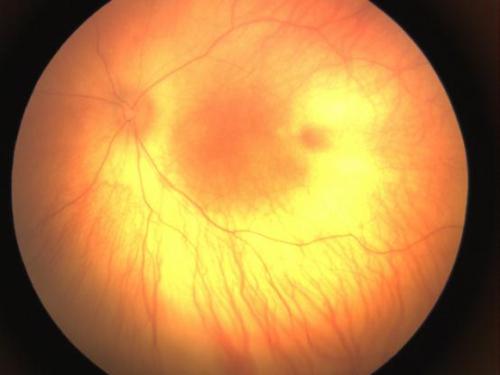 视网膜母细胞瘤的前兆图片